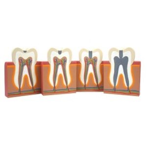 충치모형 4단계 충치 치아모형 치아모형수업 학교용